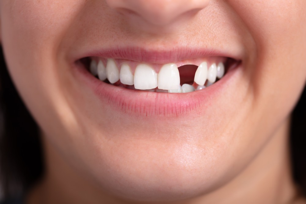 5 Different Ways to Replace a Missing Tooth